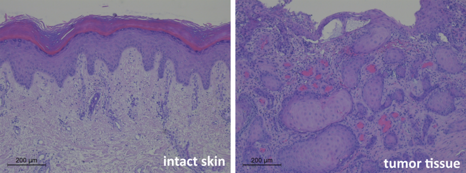 Intact skin vs. tumour tissue Image manipulation (c) EB House Austria